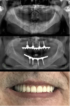 Protocolo em maxila e mandíbula atrófica sem enxerto.