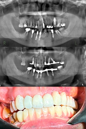 Protocolo em maxila atrófica sem enxerto. Usando o osso residual do pilar canino.